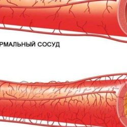 Атеросклероз нижних конечностей отек стопы трофическая язва чем лечить