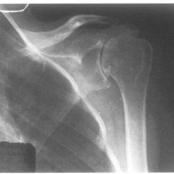 Перелом внутреннего надмыщелка плечевой кости у детей