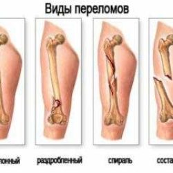 Комплекс упражнений для восстановления после перелома бедра