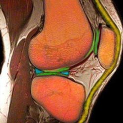 Перелом мениска коленного сустава симптомы и лечение