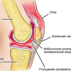 После ушиба колена собралась подкожная жидкость