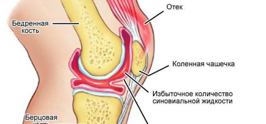 После ушиба колена собралась подкожная жидкость