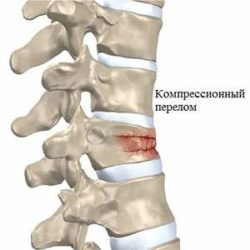 Физиолечение при компрессионном переломе позвоночника у детей