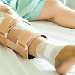 Первые признаки перелома ноги в области колена