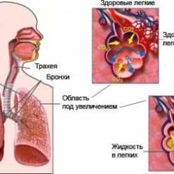 Отек легких при воспалении легких у взрослых