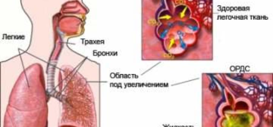 Отек легких при воспалении легких у взрослых