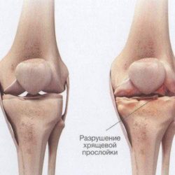 Боль сзади коленки при ходьбе нога не разгибается ушиба нет