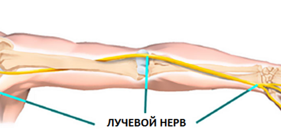 Симптомы повреждения лучевого нерва при переломах плеча