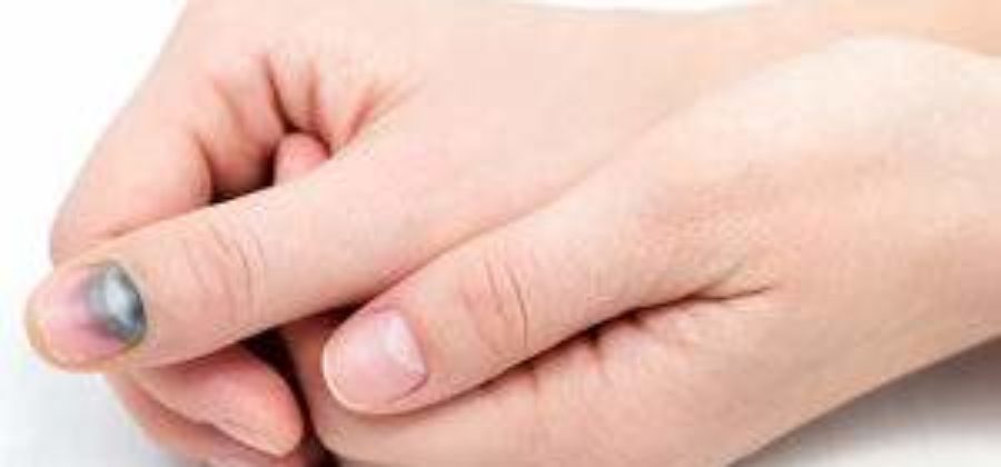 Сильный ушиб пальца на руке ноготь посинел опух чем лечить