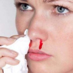 Как остановить кровотечение из носа после ушиба в домашних условиях?
