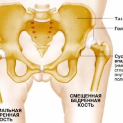 Врожденный вывих тазобедренного сустава последствия у детей