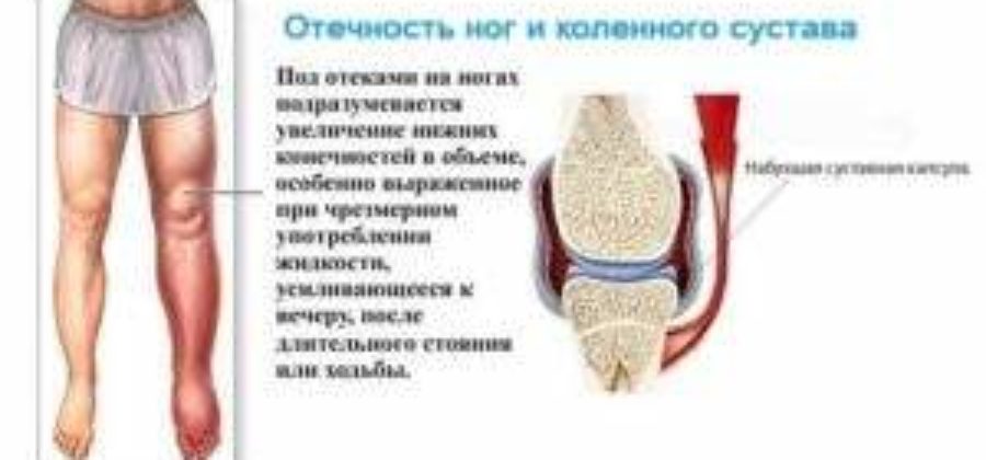 Отек ноги выше колена причины и лечение