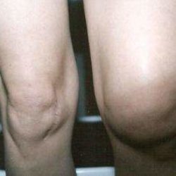 Боль в суставах колена и бедра отек ноги внизу ноги
