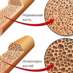 Что такое компрессионный перелом позвоночника при остеопорозе?