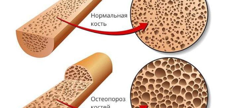 Что такое компрессионный перелом позвоночника при остеопорозе?