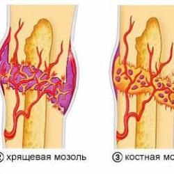 Когда образовывается костная мозоль при переломе челюсти