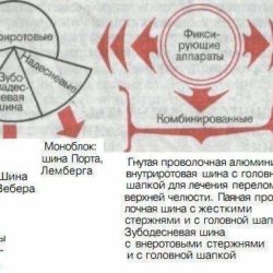 Классификация ортопедических аппаратов для лечения переломов челюстей