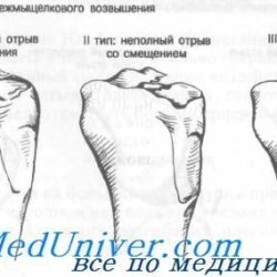 Перелом заднего края дистального метаэпифиза большеберцовой кости