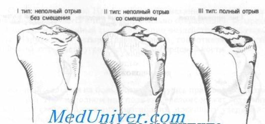 Перелом заднего края дистального метаэпифиза большеберцовой кости