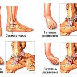 Отек при растяжении связок голеностопного сустава после гипса