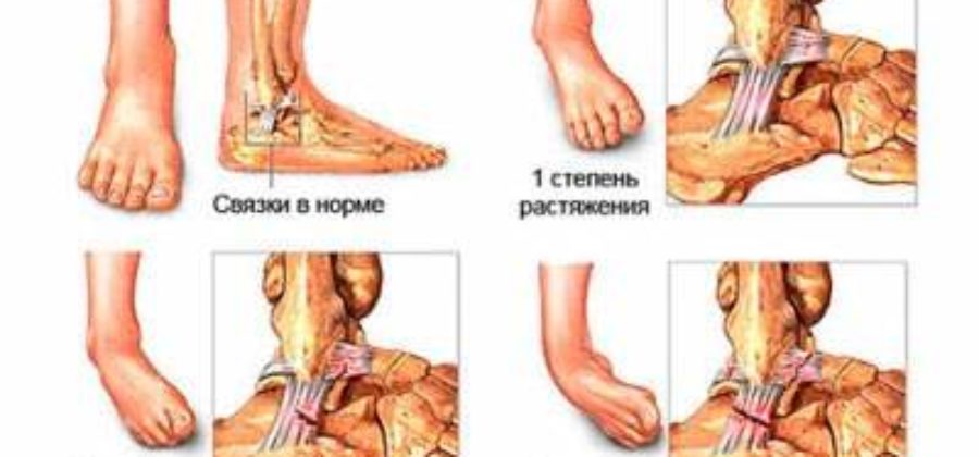 Отек при растяжении связок голеностопного сустава после гипса