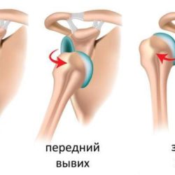 При вывихе в суставе суставная головка выходит из суставной впадины