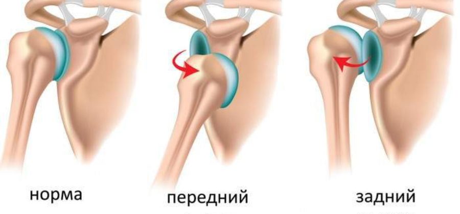 При вывихе в суставе суставная головка выходит из суставной впадины