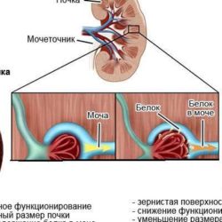 Белок в моче без отеков и давления при беременности