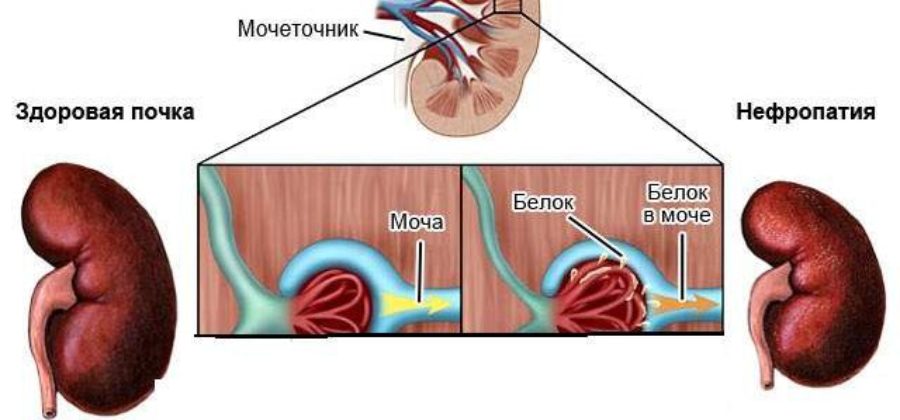 Белок в моче без отеков и давления при беременности