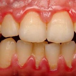 Отек десны возле зуба лечение в домашних условиях