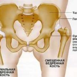 Лечения вывихов тазобедренных суставов у детей после года