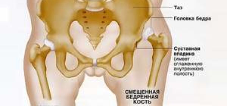 Лечения вывихов тазобедренных суставов у детей после года