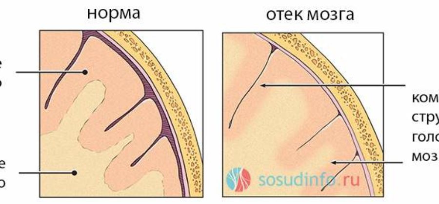 Отек головного мозга чем снять в домашних условиях