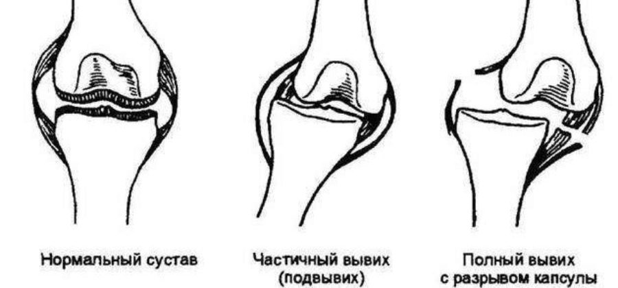 Ваши действия при вывихе сустава у занимающегося