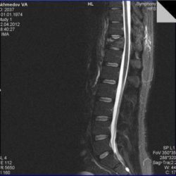 Компрессионный перелом тела l1 позвонка 1 степени