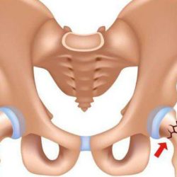 Перелом тазобедренного сустава со смещением время заживления