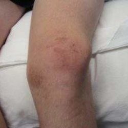 Ушиб мягких тканей в области коленного сустава