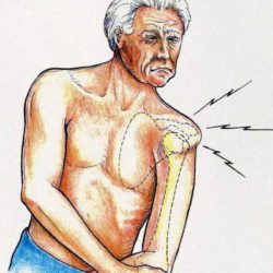 Как вылечить привычный вывих плечевого сустава народными средствами?
