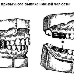 Первая помощь при вывихе нижней челюсти во время удаления зуба