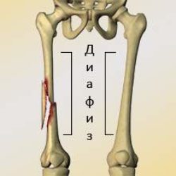 Для переломов диафиза бедренной кости характерен механизм