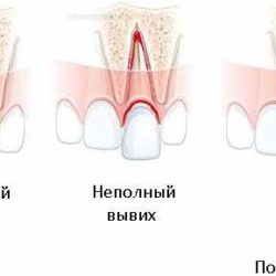 Тактика врача при полном вывихе одно или двухкорневого зуба