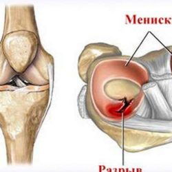 Боль в колене при сгибании после ушиба