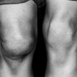 Боль в коленном суставе и отек ниже колена