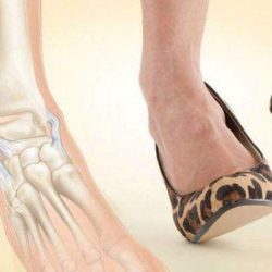 Ушиб и растяжение связок на ноге чем лечить