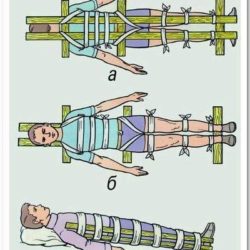 Транспортировка при переломе верхних и нижних конечностей