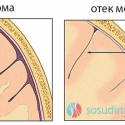 Отек мозговых оболочек и переполнение внутренних органов кровью