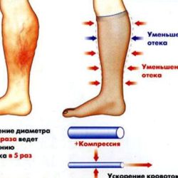 Лимфостаз нижних конечностей чем грозят отеки ног