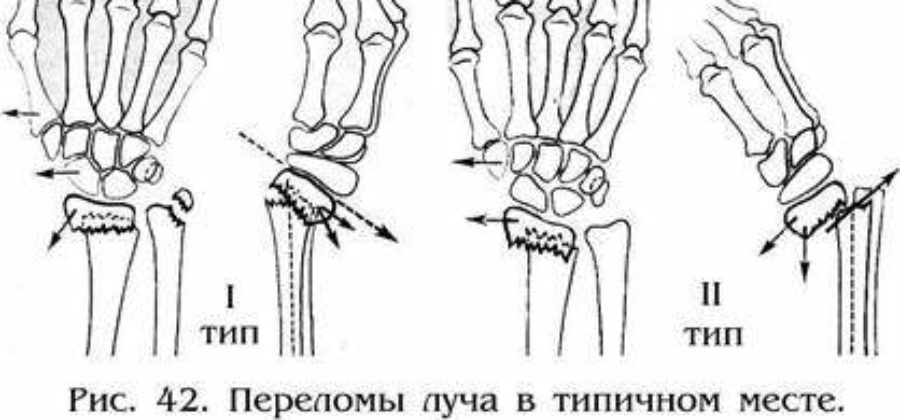 Ротационные смещения при переломе костей предплечья зависят