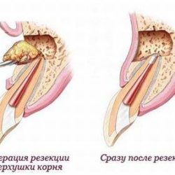 Как снять отек после резекции верхушки корня зуба?