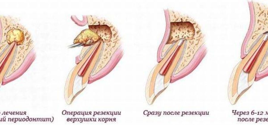 Как снять отек после резекции верхушки корня зуба?